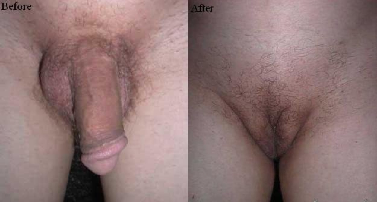 pussy pics after sex change